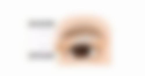 20年前埋线双眼皮到底拆不拆？了解强制拆线场景与非必要情况，助你科学抉择 