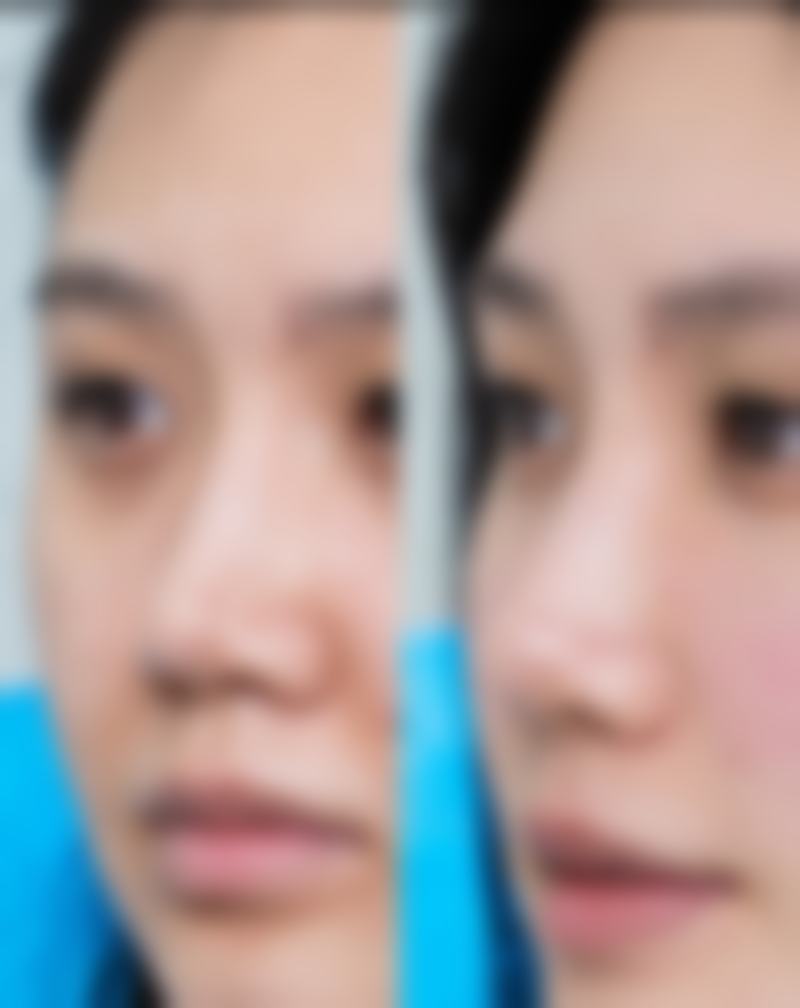 20年前埋线双眼皮,哪些情况要强制拆线?