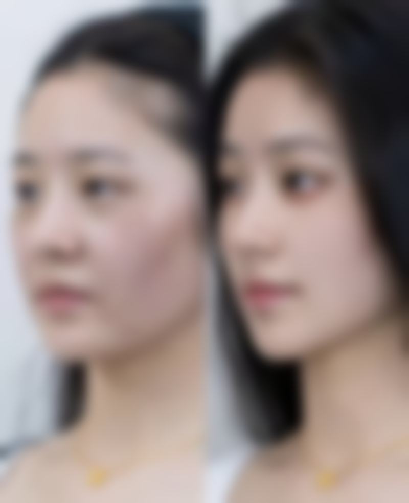 割双眼皮术后热敷，温度和操作方法要注意啥？