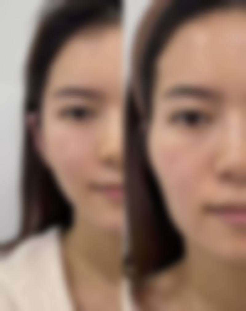 面部抽脂可能有哪些副作用?降低风险与术后护理特别重要
