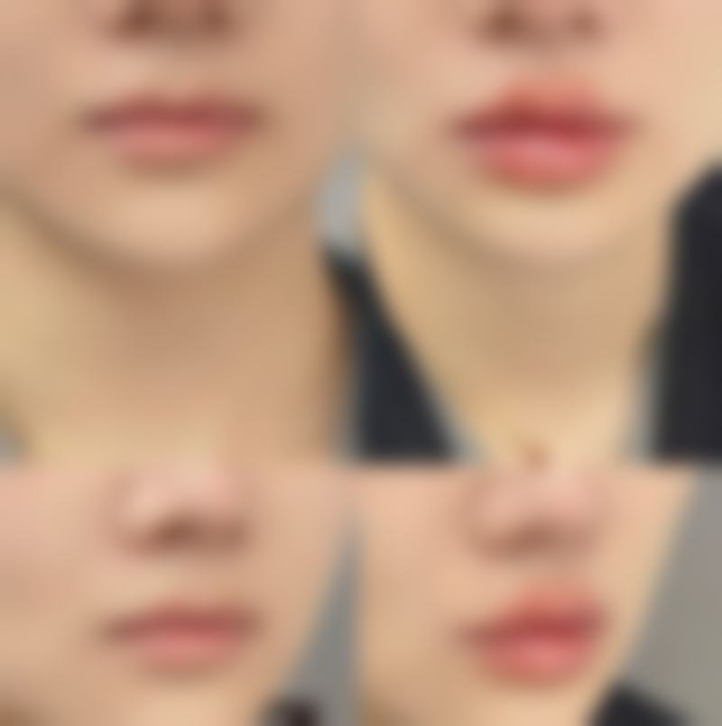 割双眼皮肿胀时长揭秘:常见的肿胀阶段