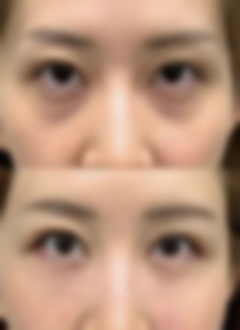 脸部吸脂成效究竟好不好?改善轮廓成效显著
