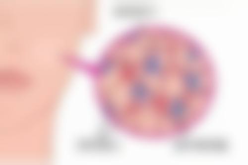 隆胸假体究竟会不会破？揭秘正常受力不破原因、异常破裂诱因及处理方式 