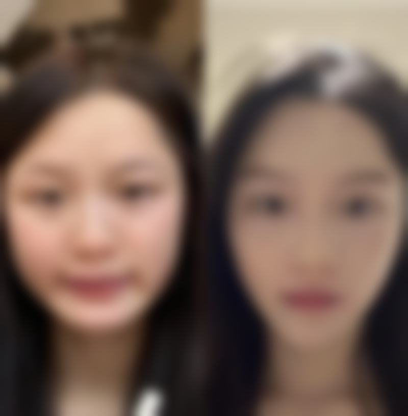 日常辅助改善,助力美胸修复