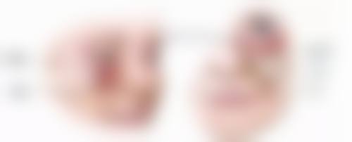抗疤痕药物与物理干预:双管齐下成效好