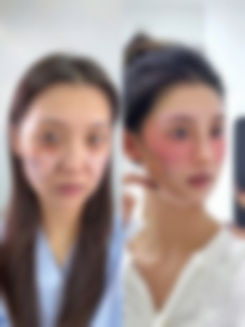 如何快速搞定眼袋淤青?按摩促进吸收有妙招