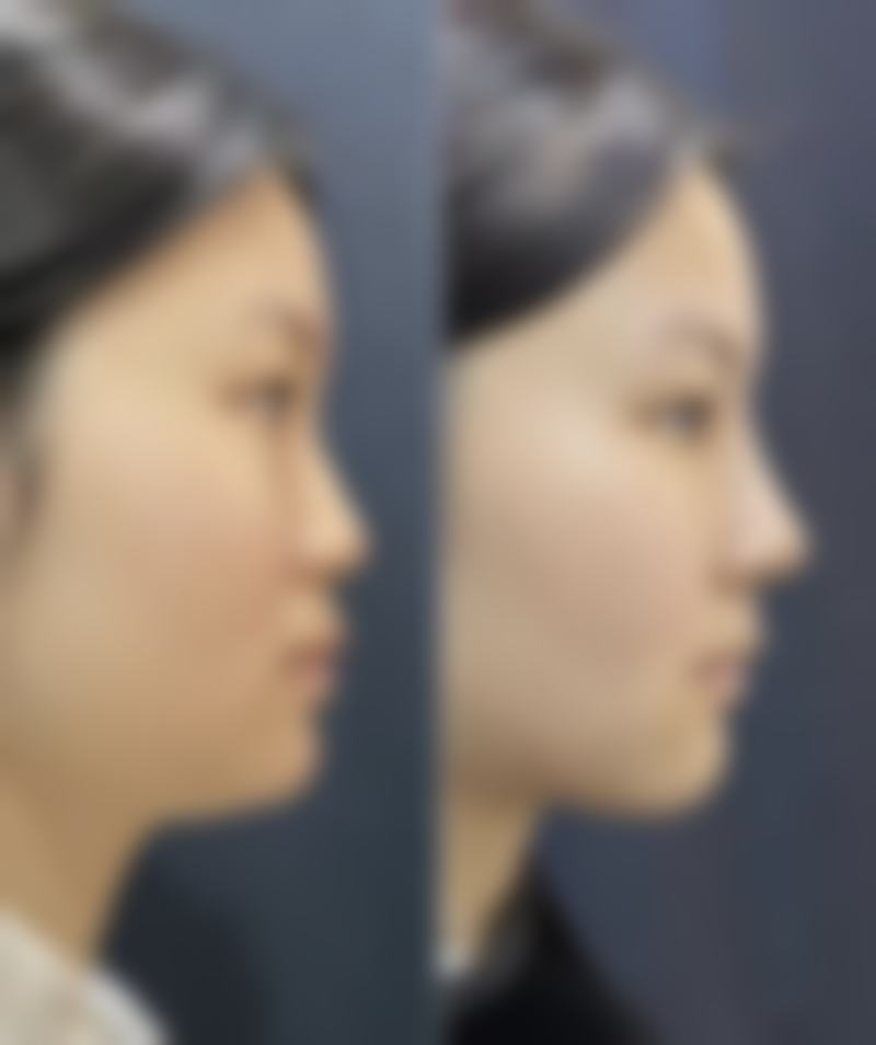 五、南京恒丽整形医院实例