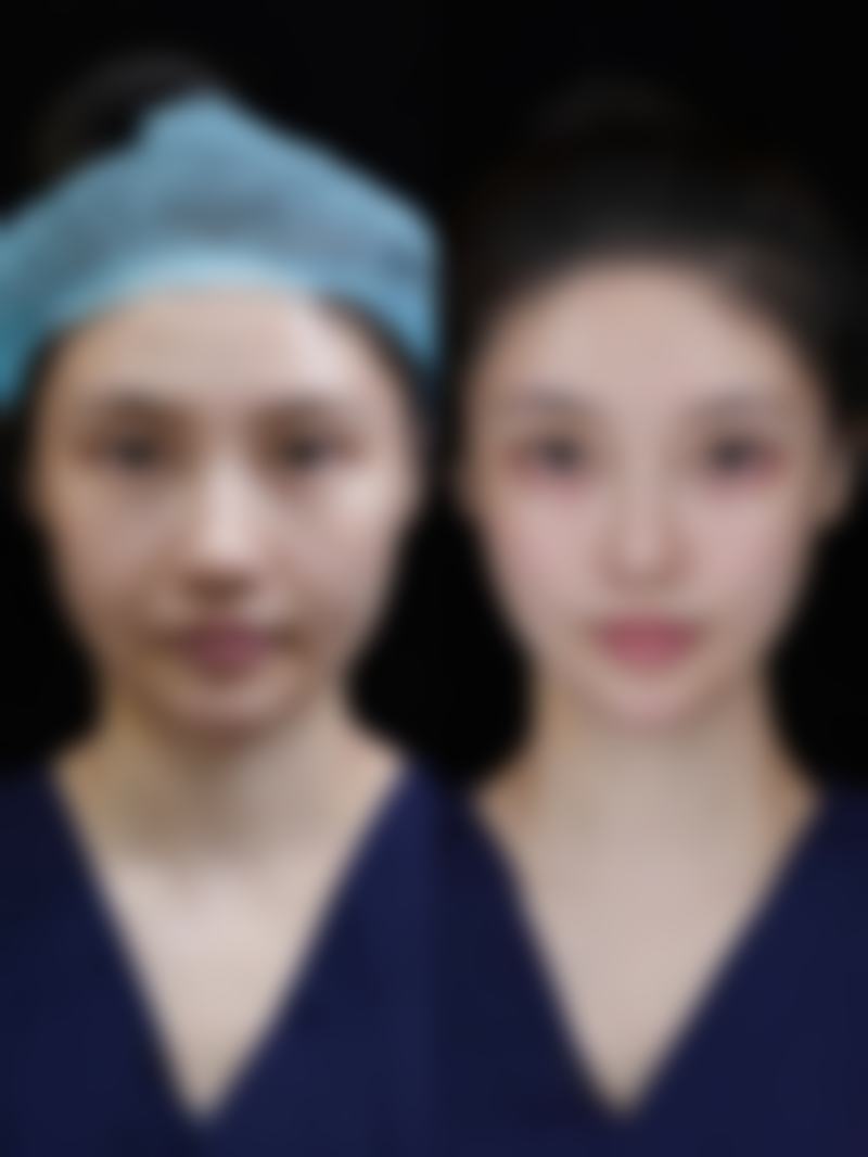 隆鼻后不小心碰到了,碰撞后该怎么处理与护理?