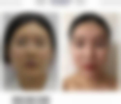面部吸脂术手术流程和修复情况如何?了解一下