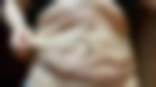 面部吸脂术效果究竟如何？立竿见影瘦脸，还能长久维持、促进皮肤弹性增加！ 