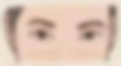 割双眼皮接近修复：自然灵动初现