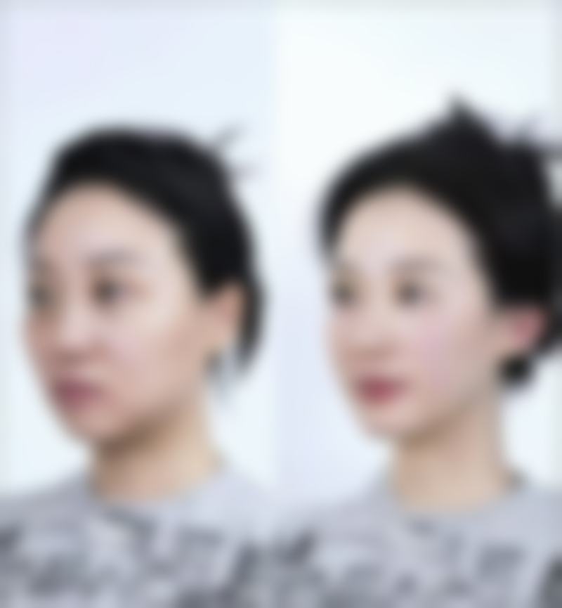 选三点定位还是全切？从手术操作看两种术式优势