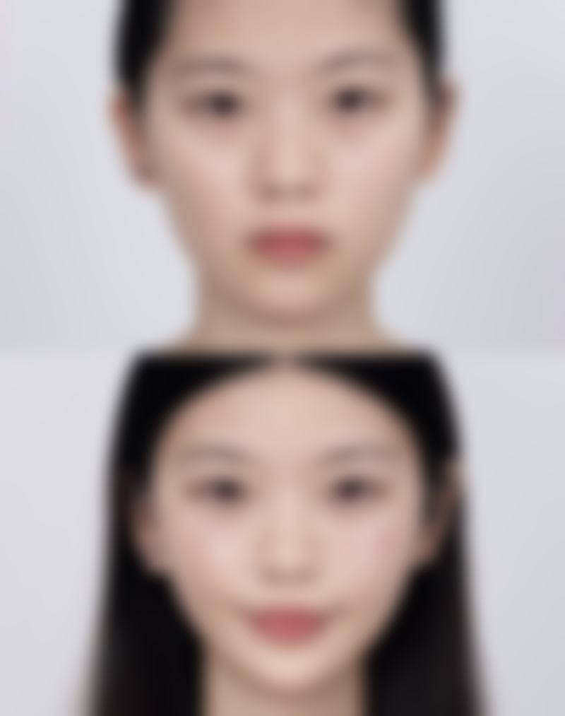 揭秘影响隆鼻寿命的核心因素之手术技术