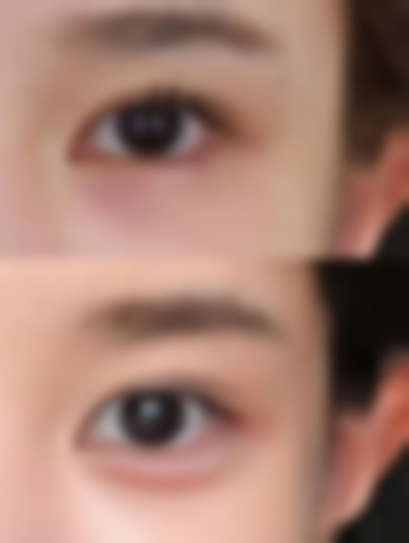 割双眼皮修复揭秘:修复阶段划分